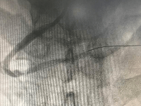 胸痛|30年烟龄大叔突发心梗，天气骤冷，小心心脏发动机油管崩坏