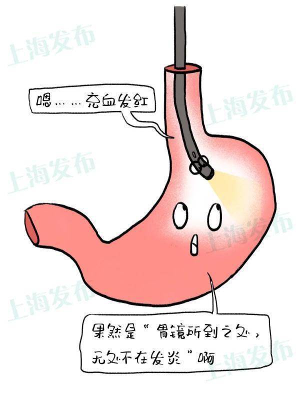 浅表性胃炎报告单图片图片