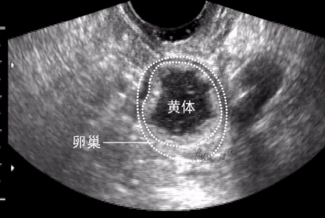 各時期正常女性生殖器官的超聲聲像表現!_子宮