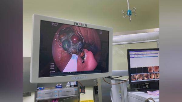 家长|4岁男童出现咳嗽、发烧症状，结果胃里取出34颗磁力珠……