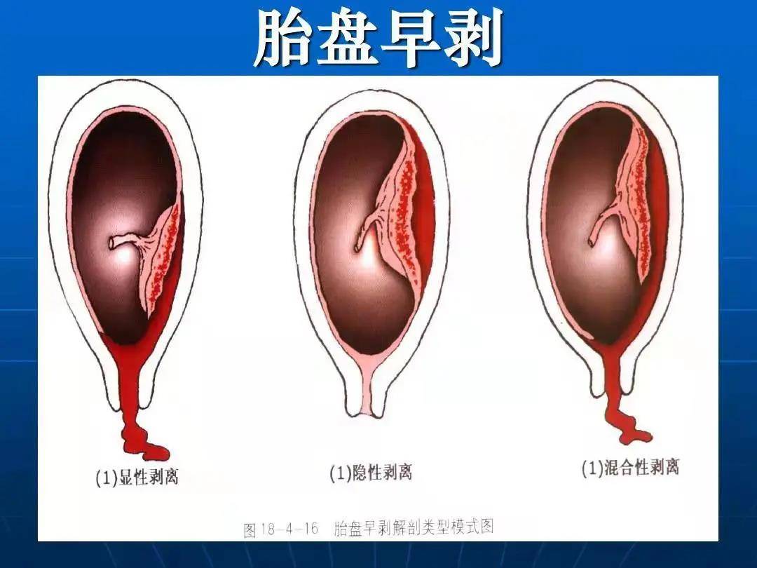 縣域大健康是見紅還是胎盤早剝孕晚期的準備媽媽可得分清