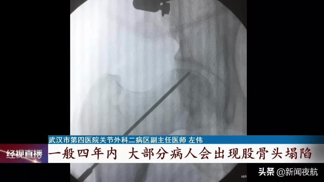 关节|27岁小伙长期喝它，股骨头竟成黑色！很多人都爱喝