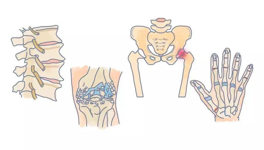 在芮主任病房中的髋部骨折患者, 绝大多数都是高龄,伴有骨质疏松的人