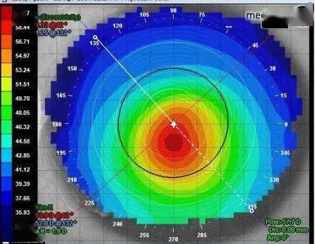 正常角膜地形图medmont角膜地形图仪通过非接触方式可以测量到人眼角
