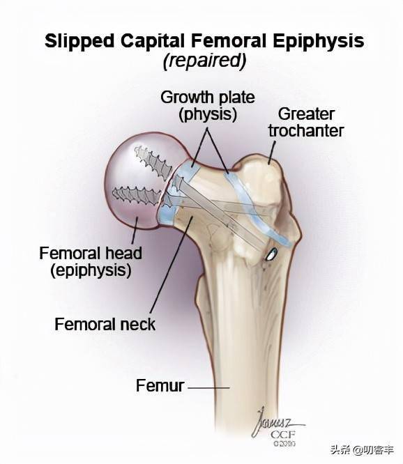 股骨干骺端图片图片