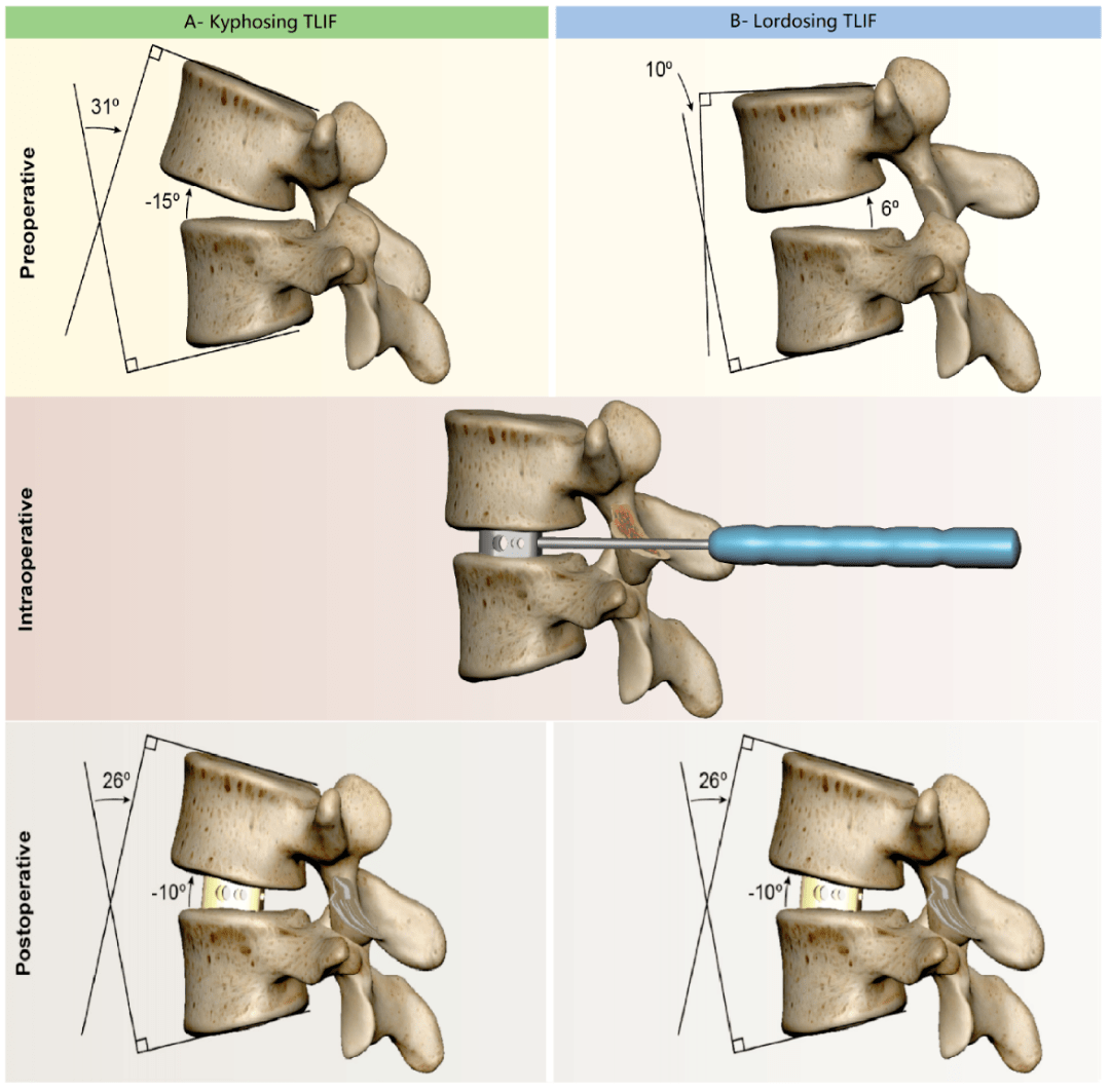 tlif手术究竟是导致腰椎前突还是后突?