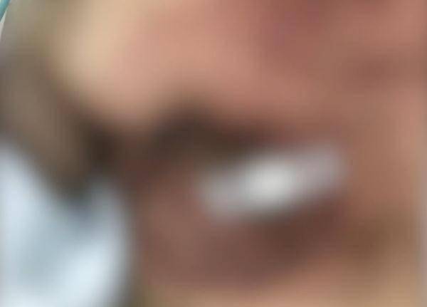 余先生|广东一男子乳下皮肤溃破，一查是乳腺癌？这个症状要注意