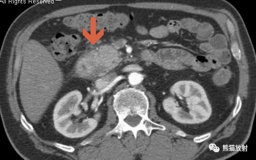 实质|沟槽区胰腺炎丨临床及影像表现