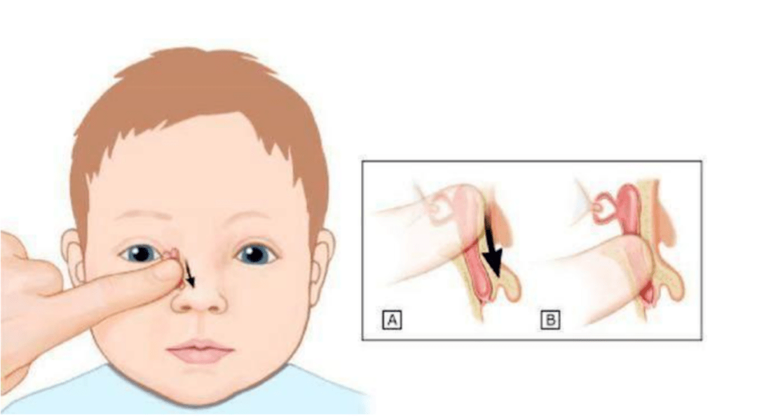 婴儿泪囊区按摩手法