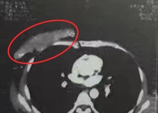 余先生|广东一男子乳下皮肤溃破，一查是乳腺癌？这个症状要注意