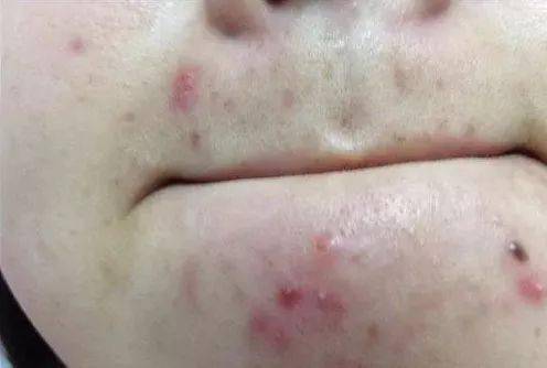 突如其来的姨妈痘如何甄别和预防护理