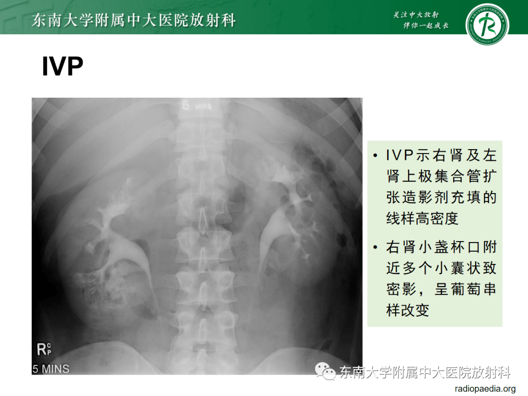 髓质海绵肾CT图片