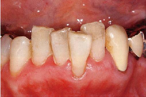 由于刷牙过度会进一步引起牙龈萎缩,根面磨耗,根面龋,牙周炎恶化,需要