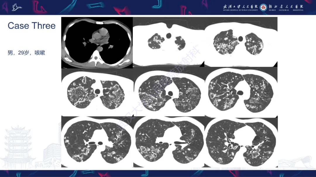 活动性肺结核不典型ct表现