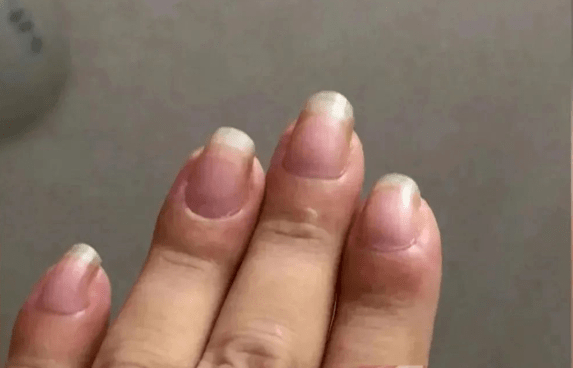 深圳一女子十个手指头变得越来越粗,检查发现竟是