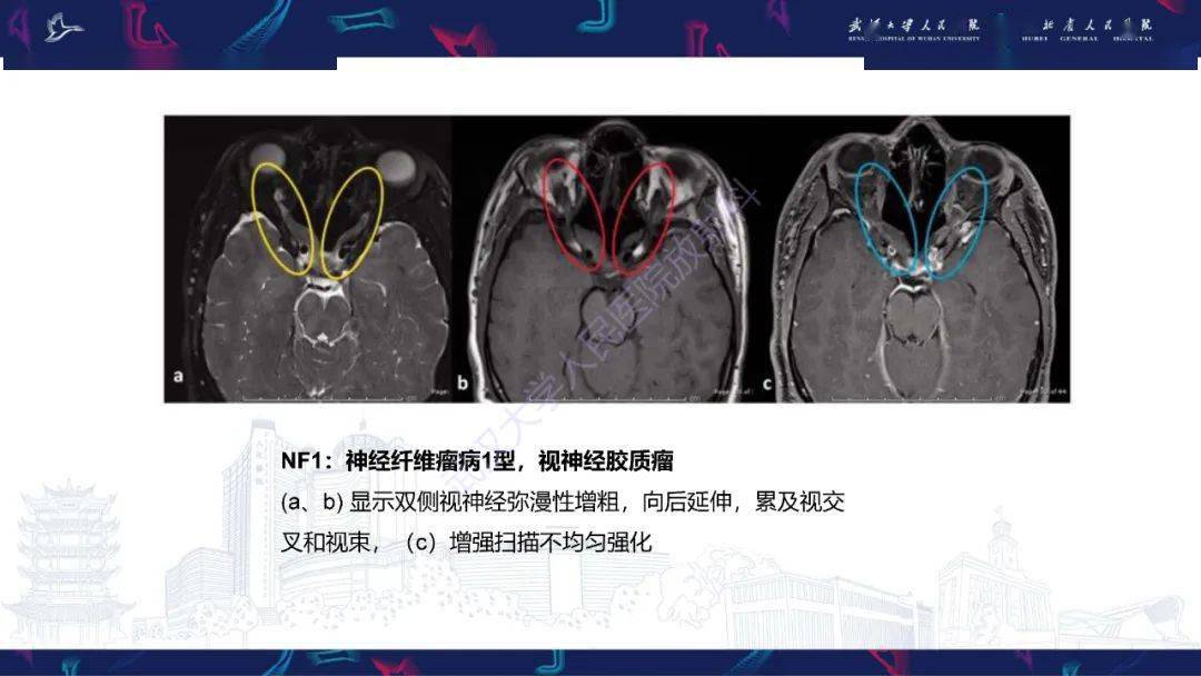 眶尖疾病影像诊断