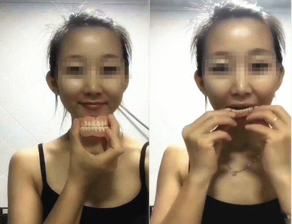 自己因重度牙周病未及时治疗,导致满口牙齿松动,年纪轻轻就戴上了假牙