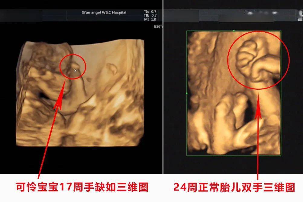 大咖科普四維三維二維超聲有什麼區別傳說中的大篩查又是什麼超聲