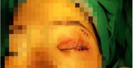 手术|吓人！广西一女子被13cm钢筋扎入眼眶，眼鼻鲜血直流……