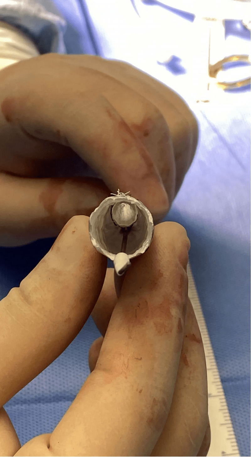 男子|男子体内藏有多枚“不定时炸弹”！医生改装“排雷”工具