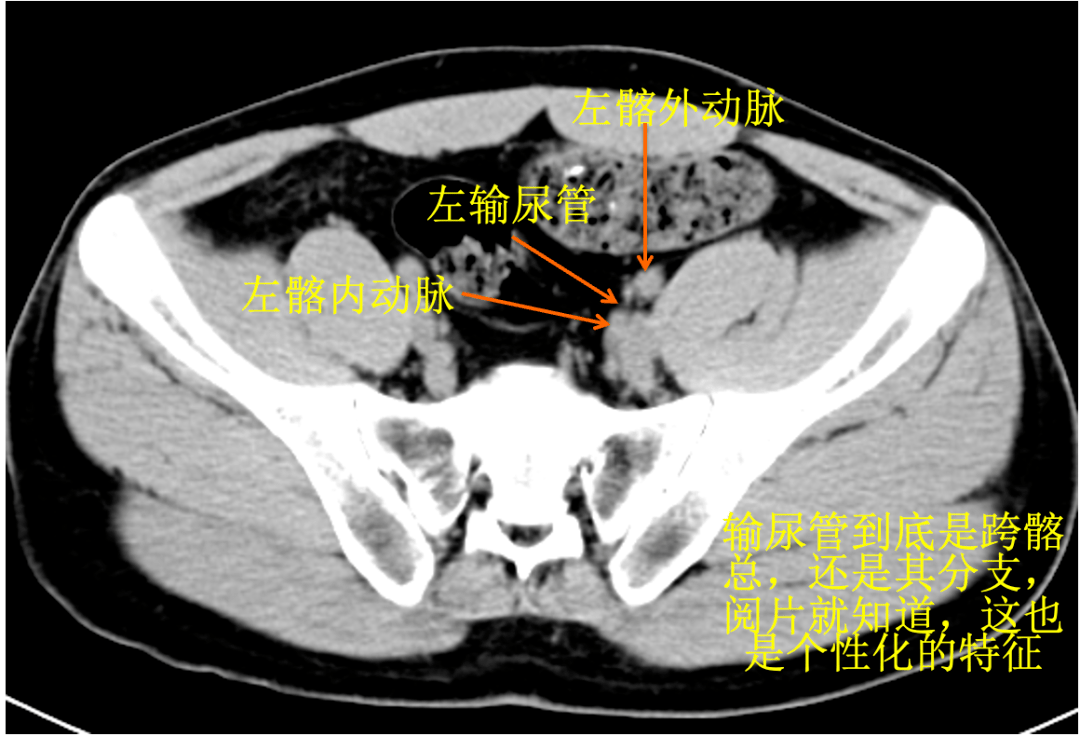 圖92 課本解剖到個性解剖圖93 髂前上棘來了圖94 肌肉的附著點的作用