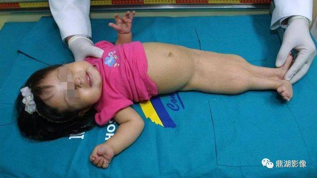 美人鱼综合征(sirenomelia病)的片子您见过吗?