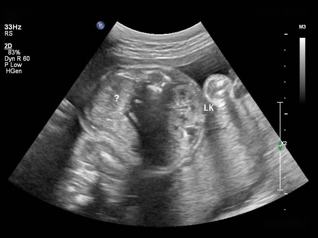 3周孩子三个睾丸图片图片