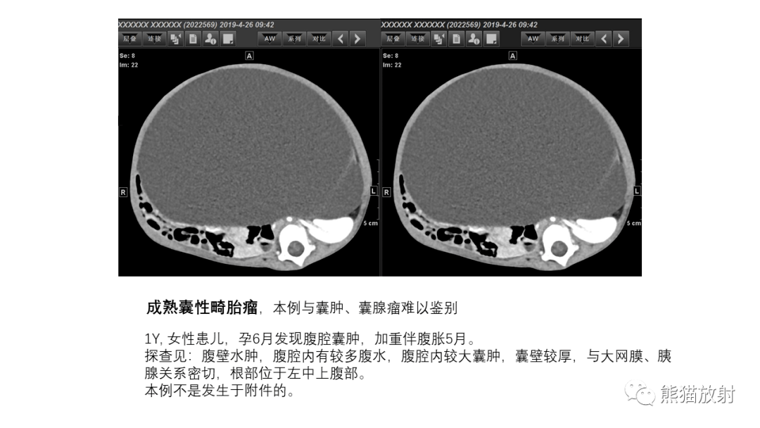 【省立影像讀片】卵巢囊性病變 21.12_內容_粘液性_漿液