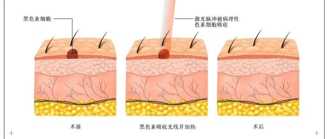 【市中医|科普】“痣”少还有你——你掌心的痣,还记得在哪里?_皮肤_激光_细胞