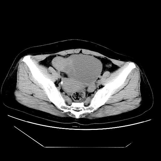右侧卵巢浆液性囊腺瘤伴卵泡膜纤维瘤b.右侧卵巢粘液性囊腺瘤c.