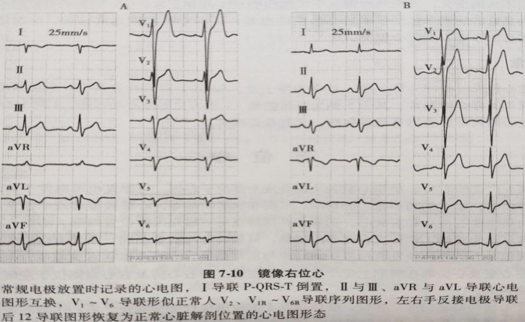 镜像右位心和左右手反接心电图如何鉴别