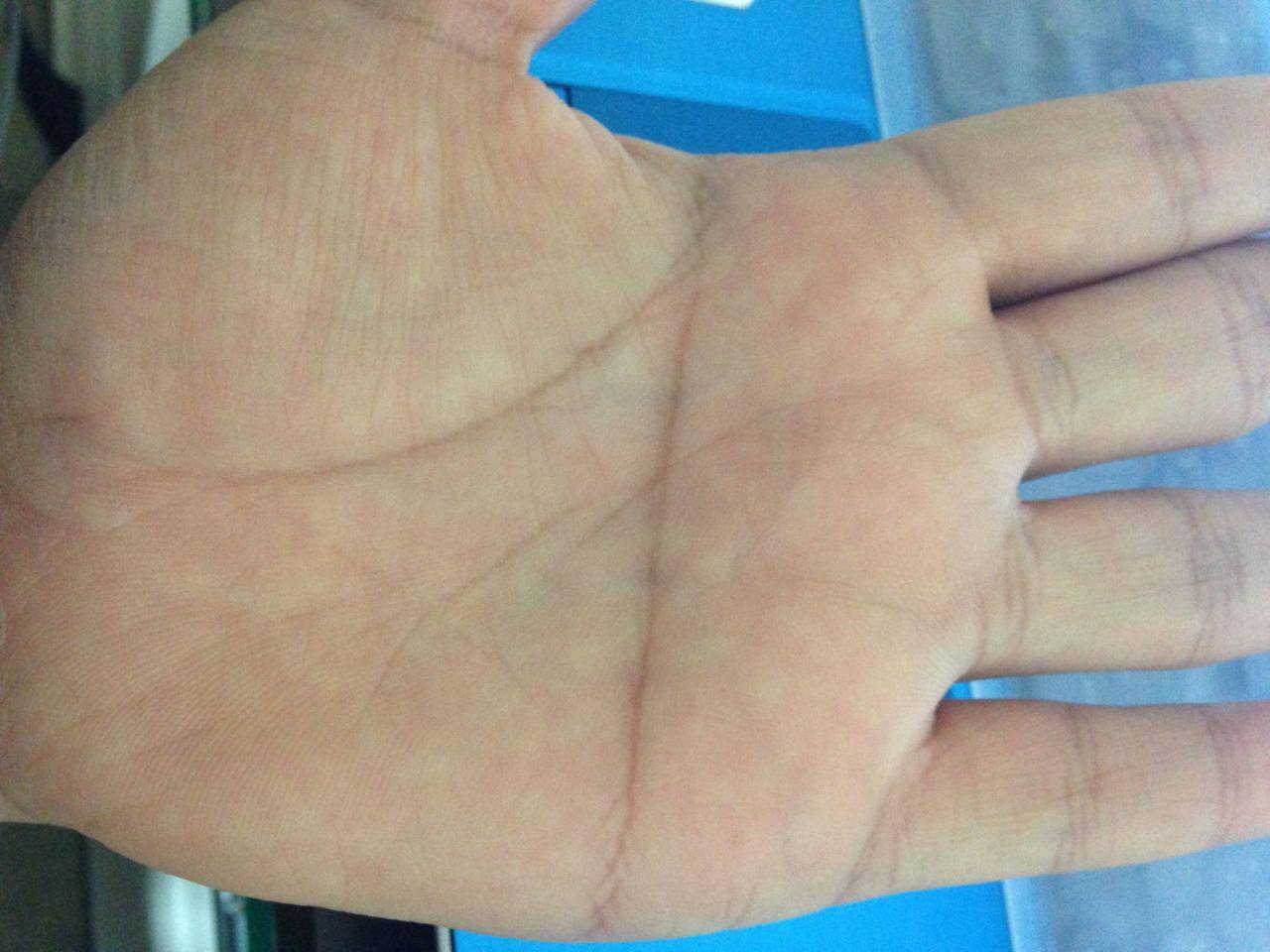 手掌颜色诊病(正常手掌颜色与健康) - 医药经