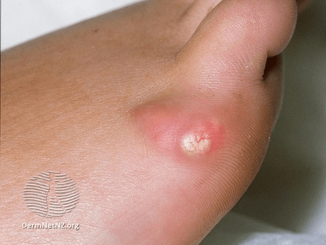 医生_疙瘩_手术