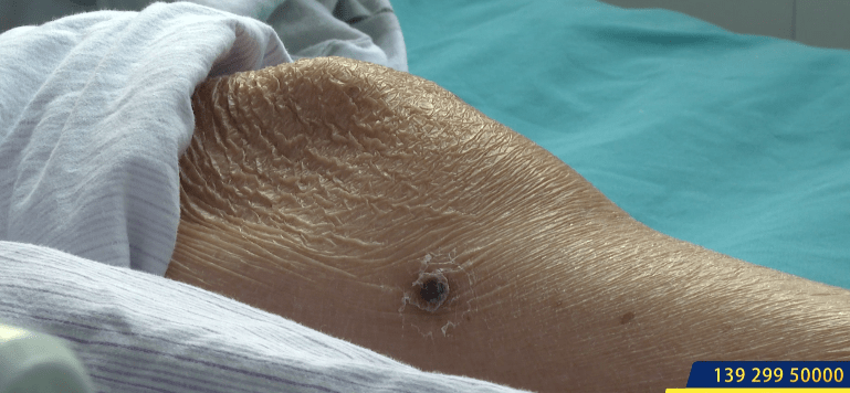 肝功能|女子逗猫后进了ICU，医生提醒：这种病在南方多发