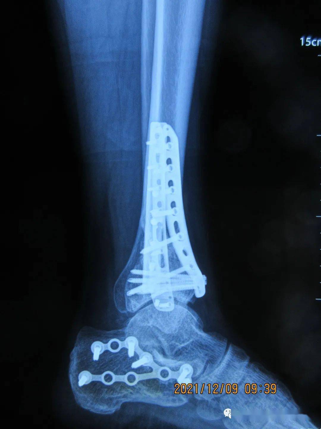 病例2:高空坠地,双侧踝关节骨折