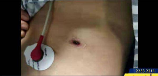 小焦|女子撸猫后住进ICU？警惕这种“小焦痂”，严重可致命