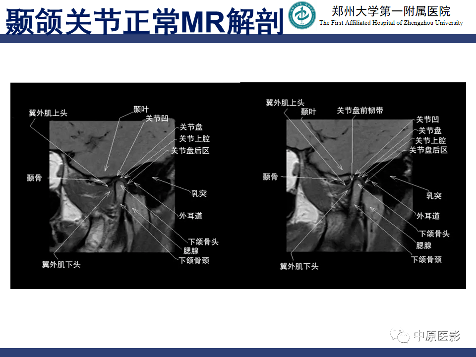 颞颌关节紊乱病的mri诊断