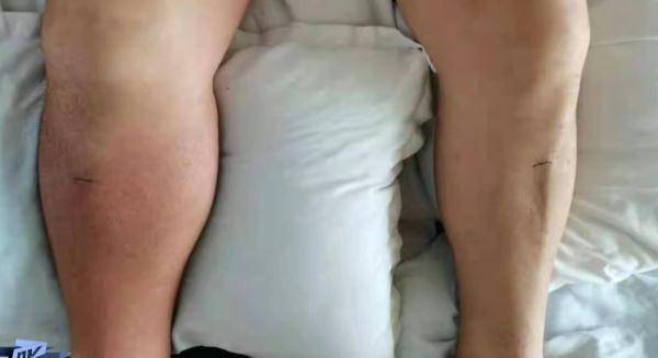 喝啤酒|广东一男子体内抽出150毫升“牛奶”，原因竟是……