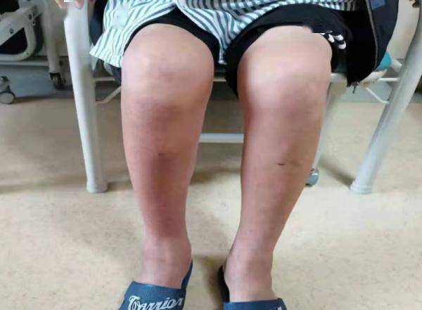 喝啤酒|广东一男子体内抽出150毫升“牛奶”，原因竟是……