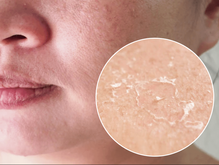 秋季脸部干燥缺水怎么办美容院diy自制天然补水面膜配方