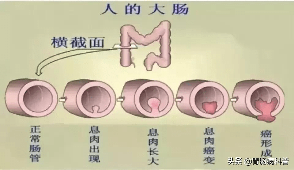 低级别管状腺瘤1级怎么办