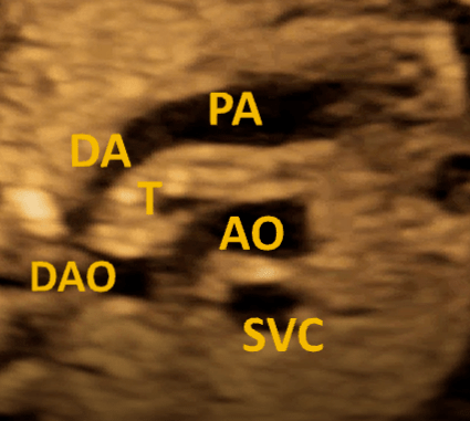 右位主动脉弓的胎儿超声心动图诊断
