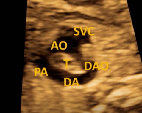 右位主动脉弓的胎儿超声心动图诊断