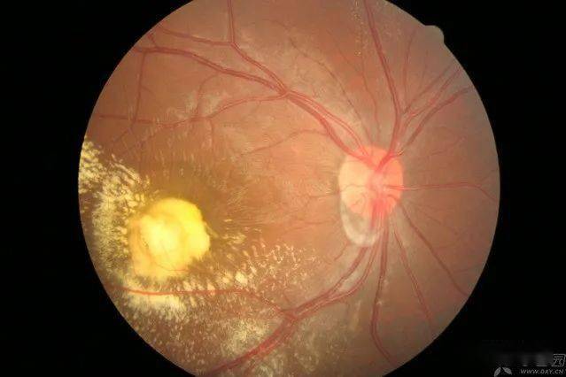 crvo网脱视盘倾斜视盘血管炎aion左眼黄斑局部动脉梗塞?