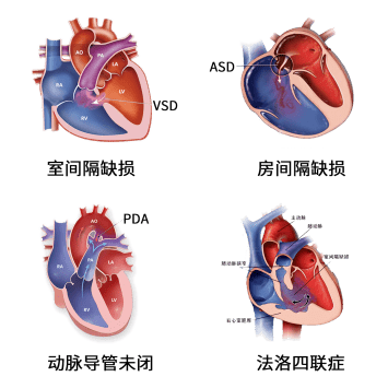疾病科普】警惕！藏在身边的先天性心脏病环境危险因素！_手机搜狐网