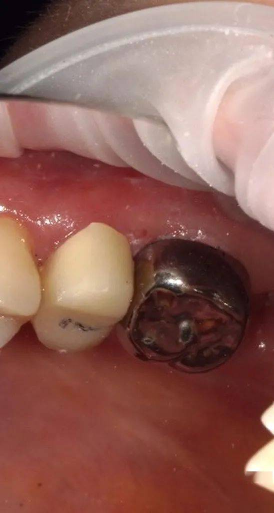 关于金属恒牙预成冠应用的思考—牙隐裂的金属预成冠临时修复