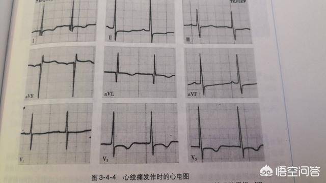 学会看心电图有用吗?