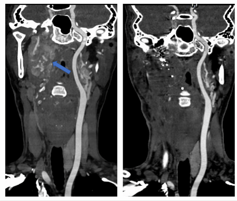 眩晕|复发颈动脉瘤“侵入”大脑引眩晕！多学科团队联手将其破拆
