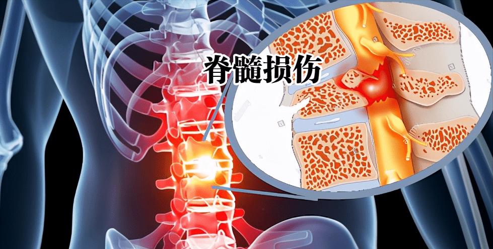 二,儿童无骨折脱位型脊髓损伤多发!小心极端动作