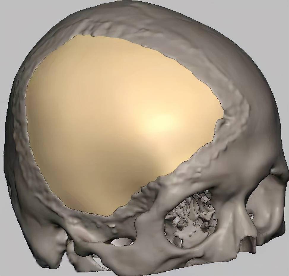 顱骨修補患者被撞鈦網凹陷拳頭大醫生修補材料很重要